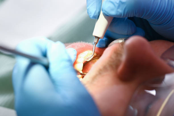 Best Emergency Tooth Extraction in Dickinson, TX