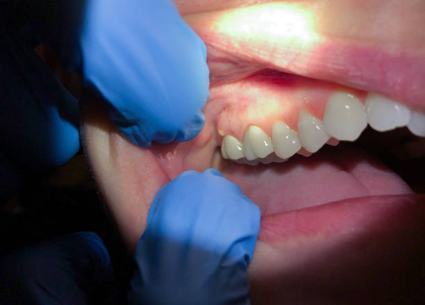 Best Emergency Dental Care for Broken or Chipped Teeth in Dickinson, TX